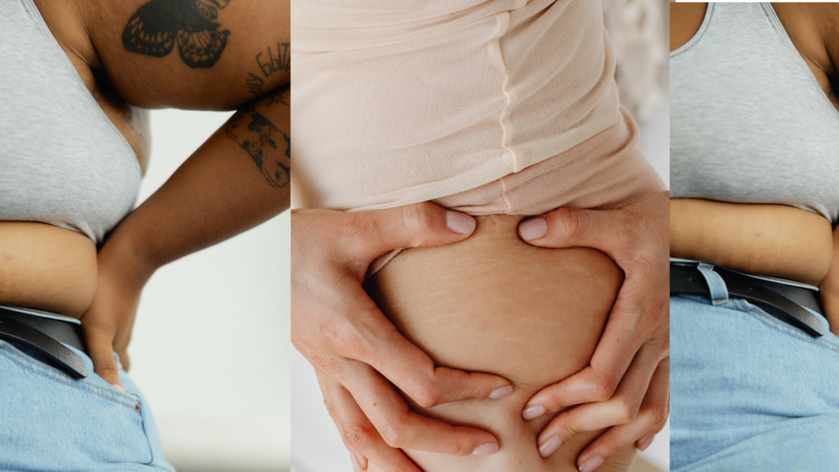 booty, stretch marks, prevent, handle